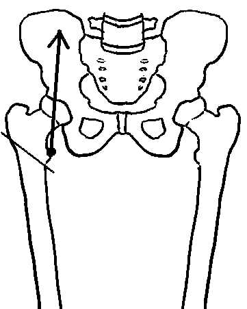 trochanteric fracture