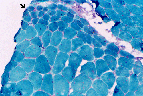 Atrophy Gif Perifascicular Muscle Atrophy