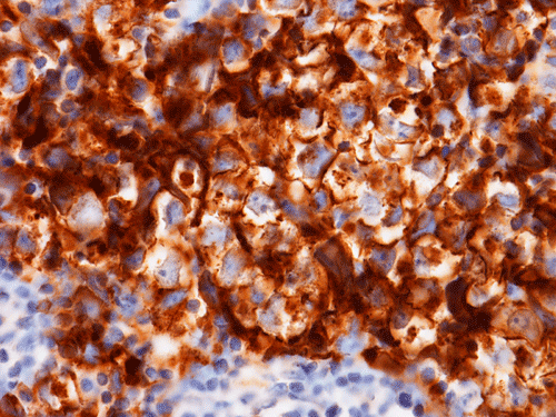 CD117: Germinoma cells are positive for CD117 ( c-kit ) which is a ...
